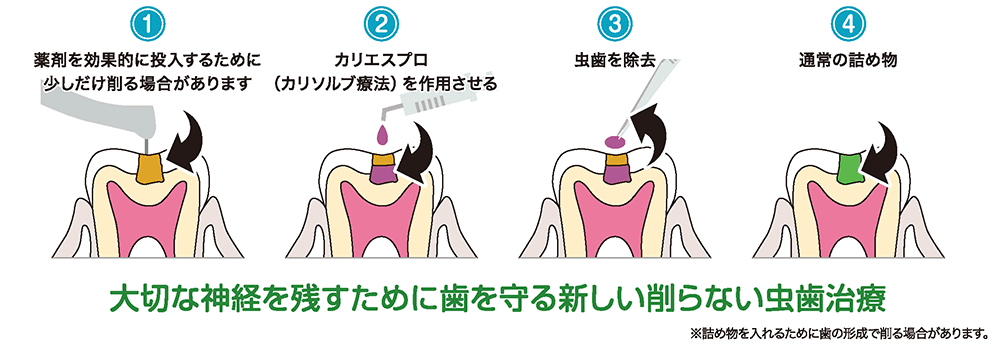 大切な神経を残すために歯を守る新しい削らない虫歯治療カリエスプロ（カリソルブ療法）