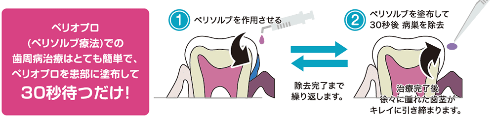 カリソルブ治療について