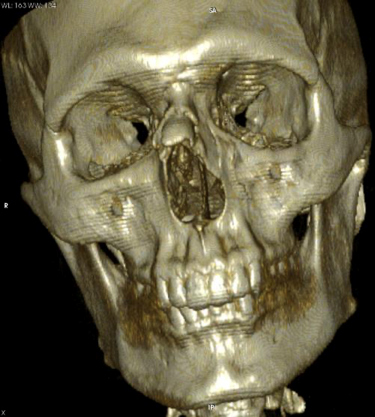 上および中顔面骨折 Jsda インターネット歯学